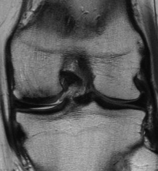 Mosaicplasty MRI Post Implantation Good Cartilage Cover